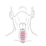 National Tracheostomy Safety Project