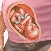 embarazoymas