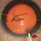 AOS Advanced Ophthalmology Surgery