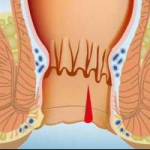 هموروئید - دستگاه دفع - گوارش