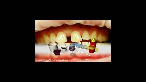 سفیدکردن دندان-دکترمجیدقیاسی