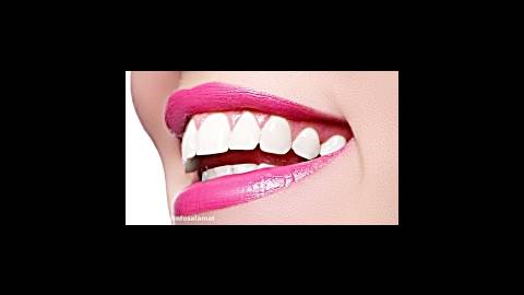 بلیچینگ یا سفیدکردن دندان | دکتر رها رادفر | اینفوسلامت