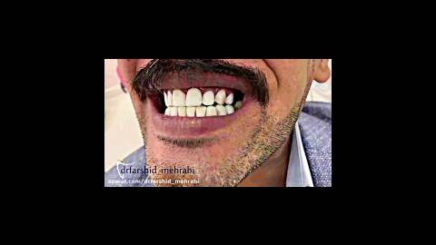 فیلم کامپوزیت دندان، کامپوزیت ونیر دندان