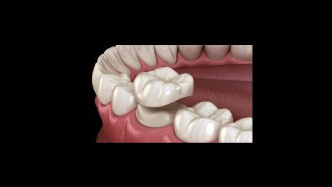 فیلم: روکش دندان چیست؟ به زبان ساده