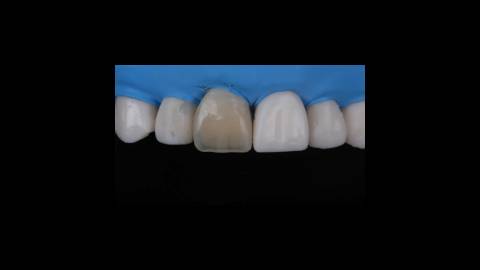 کامپوزیت دندان چیست؟ تفاوت کامپوزیت و لامینیت