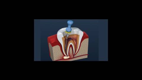 عصب کشی دندان چیست و چرا انجام می شود؟