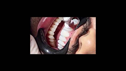 زیبایی دندان ونیر کامپوزیت