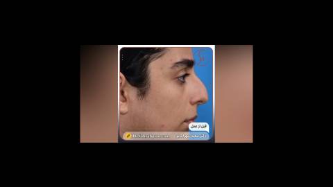 عمل زیبایی بینی توسط بهترین جراح بینی در تهران