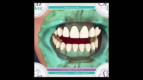 بلیچینگ - سفیدکردن دندان | دندانپزشکی سیمادنت