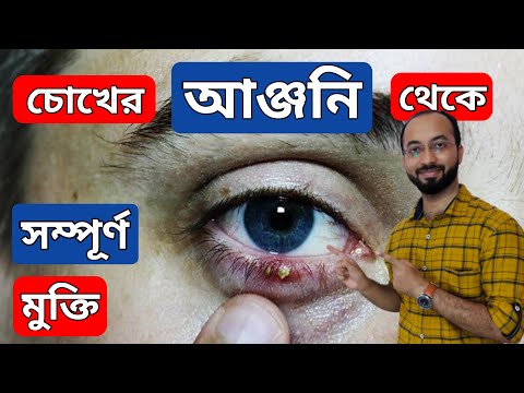 How to get relief from Stye | চোখের আঞ্জনি থেকে সম্পূর্ণ মুক্তি | Stye treatment | Stye | আঞ্জনি