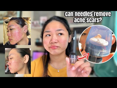 🪡 Needles can remove ACNE SCARS?