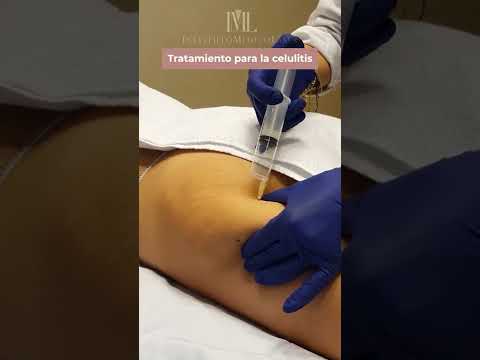 💉 Ozonoterapia contra la celulitis