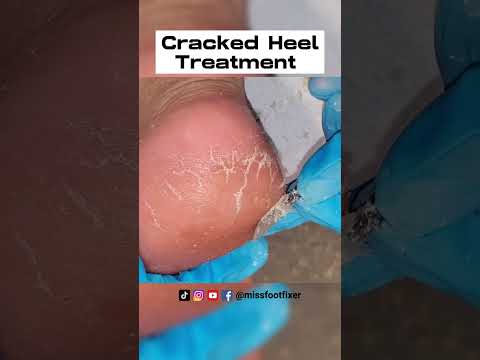 Remove Cracked Heels - So satisfying, 6 mins Cracked heel treatment by miss foot fixer