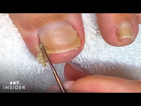 How Toenails Are Professionally Cleaned