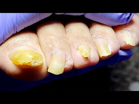 Complete pedicure procedure to restore healthy toenails【Podiatry Clinic】