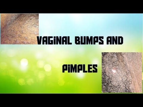 Vaginal Acne and Pimples