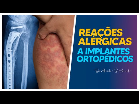 REAÇÕES ALÉRGICAS A IMPLANTES ORTOPÉDICOS: COMPREENDENDO OS SINAIS E SINTOMAS